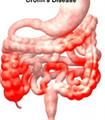 file/ELEMENTO_NEWSLETTER/14270/Crohn_morbo.gif
