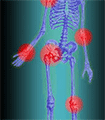 file/ELEMENTO_NEWSLETTER/14272/malattie_reumatiche.gif